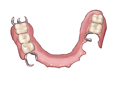 部分入れ歯の特徴